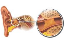 آشنایی با شایع‌ترین علل گرفتگی موقت گوش